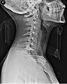 Side view X-ray of the neck with a cervical collar