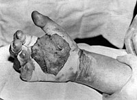 Harry K. Daghlian's blistered and burnt hand, photographed on August 30, 1945, after he received his fatal radiation dose. He died 16 days after this photo was taken.