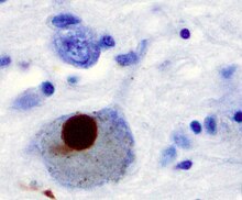 藍染的細胞為腦神經細胞，其中最大的一顆細胞含有棕色的路易氏體構造，其直徑占總細胞直徑的40%。