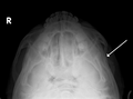 Fracture of the zygomatic arch as seen on plain X-ray