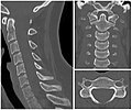 Scrollable computed tomography images of normal cervical vertebrae
