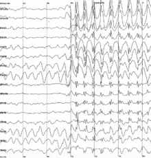 An electroencephalogram of a person with childhood absence epilepsy showing a seizure. The waves are black on a white background.