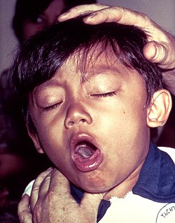 طفل يسعل نتيجة إصابته بالسعال الديكي.
