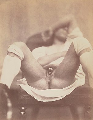 49. Hermaphrodite, part of a nine-part 1860 medical photo-documentation of an intersex person, believed to be the first of its kind.
