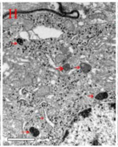 Electron microscope image of glial cell from SNc showing structures similar to ferritin in placental tissue