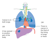 IV փուլը թոքի քաղցկեղի