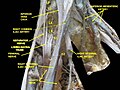 Lumbosacral plexus Deep dissection.
