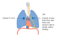 IIA փուլը թոքի քաղցկեղի