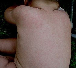 Один з найчастіших варіантів перебігу інфекції, яку спричинює герпесвірус людини 6-го типу — раптова екзантема у дітей. Типовий розеольозний висип на спині