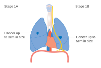 IA և IB փուլը թոքի քաղցկեղի