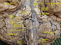 Cerebrum.Inferior view.Deep dissection