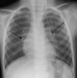 Типові двобічні затемнення на рентгенограмі органів грудної клітки у дитини з тяжким перебігом респіраторно-синцитіальної інфекції
