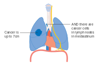IIIA փուլը թոքի քաղցկեղի