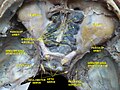 Ethmoid sinus. Ethmoidal air cells.Deep dissection. Superior view.