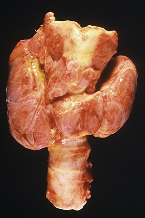 Thyroid, Diffuse Hyperplasia.jpg