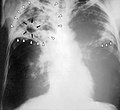 Tubercolosi polmonare in RX torace. Le frecce indicano il granuloma.