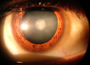 Збільшений вигляд ока людини із катарактою при освітленні дифузним світлом щілинної лампи