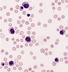 急性骨髄性白血病 (AML-M6) の血液の例。