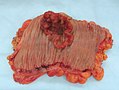 An invasive colorectal carcinoma (top center) in a colectomy specimen