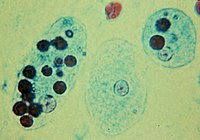 Trophozoites of Entamoeba histolytica, a disease-causing parasite with engulfed red blood cells (dark circles)