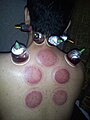 A person receiving wet cupping