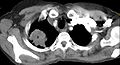 Tomografía computada que muestra un tumor de Pancoast (etiquetado como P, carcinoma pulmonar de células grandes, pulmón derecho), de una mujer fumadora de 47 años.