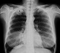 Radiografía de tórax que muestra un tumor de Pancoast (etiquetado como P, carcinoma pulmonar de células grandes, pulmón derecho), de una mujer fumadora de 47 años.