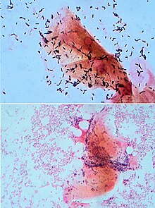 Gram-stained micrograph of bacteria from the vagina