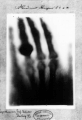 Перший рентгенівський знімок руки дружини Вільгельма Рентгена Анни Берти Людвіг, зроблений ним 22 грудня 1895 р.[16]