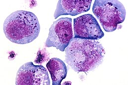 ГВЛ-6 у інфікованих клітинах у вигляді тілець, що включені як у ядро, так і до цитоплазми. Мікрофотографія, фарбування гематоксилін-еозином.