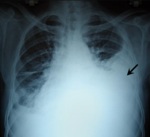 صورةٌ صدرية بالأشعة السينية تُظهر تدَمّي الصدر في الجانب الأيسر (السهم)