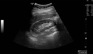 Normal adult right kidney as seen on abdominal ultrasound with a pole to pole measurement of 9.34 cm.
